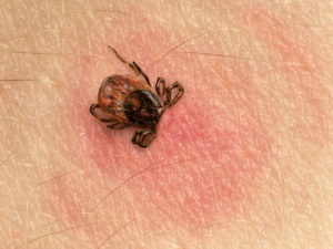 Tick Bite with Bulls-Eye