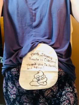 Ostomy Closed - Take Down Surgery